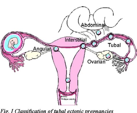 Figure I From Angular Pregnancy Presenting As Cornual Ectopic Pregnancy