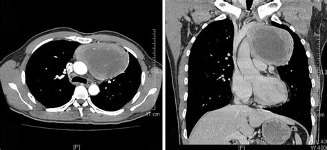 Enhanced Ct Showed A Left Anterior Mediastinal Mass With Patchy