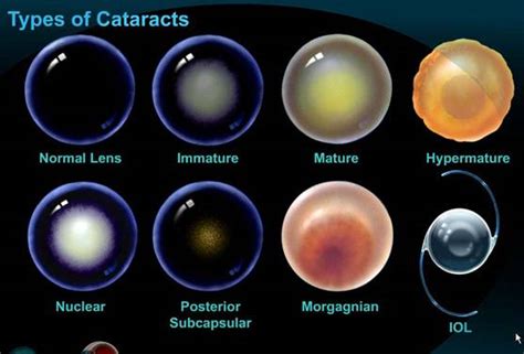 Snowflake Cataract