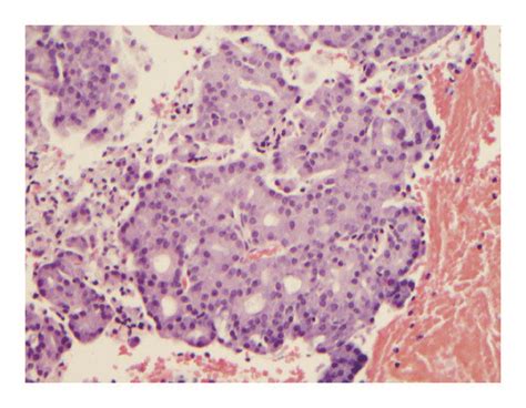 Cell Block Section From A Case Of Acinic Cell Carcinoma Exhibiting