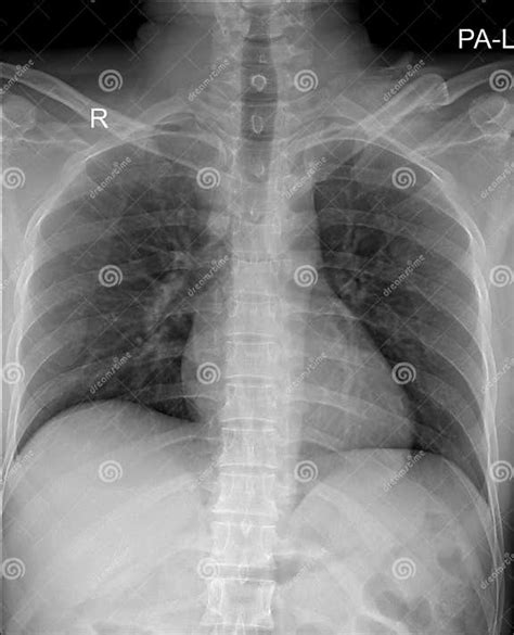 Cxr X Ray Chest X Ray A Radiographic Examination Used To Assess The