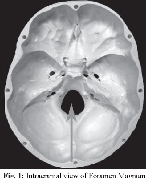 Figure 1 From Dimensions Of Foramen Magnum For Estimation Of Sex In Nepalese Population