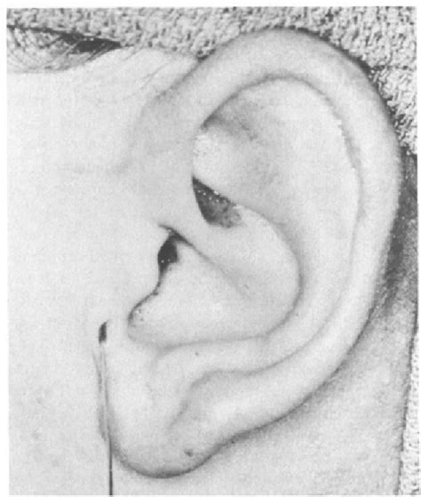 figure    branchial cleft anomalies   facial nerve