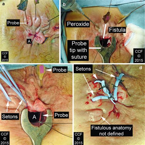Anal Fistula Crohns Disease SpringerLink