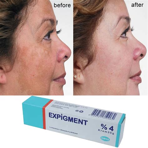 List 94 Pictures Hydroquinone Cream Before And After Pictures Stunning