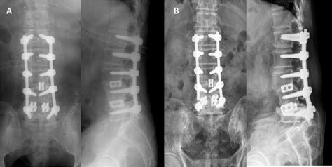 A Decompression And Fixation With Pedicle Screws Were Performed Due To