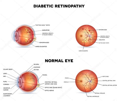 Diabetic Retinopathy And Normal Eye — Stock Vector © Megija 86827360