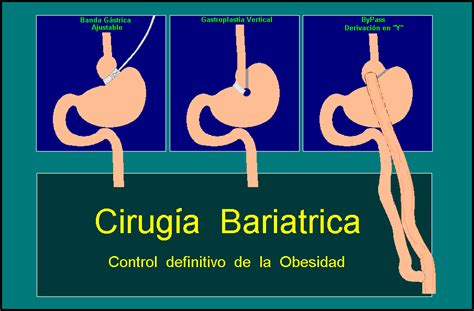 Esquemas Cirugia Bariatrica