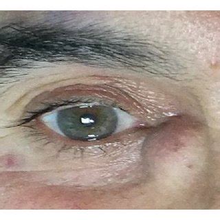 A 54 Year Old Male Patient In The Right Eye Lacrimal Sac Region A