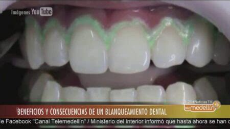 Para Que Sirve El Blanqueamiento Dental Actualizado Noviembre 2024