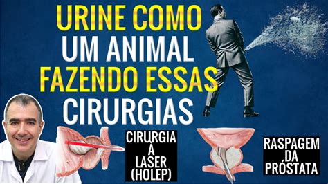 Jato de urina forte cirurgia a laser da próstata HOLEP ou