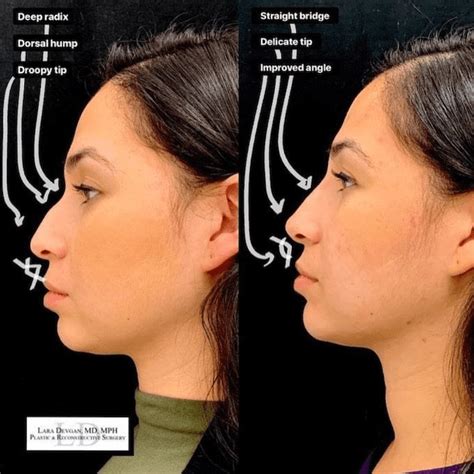 Liquid Rhinoplasty Offers A Non Surgical Nose Jobhere S What You Need