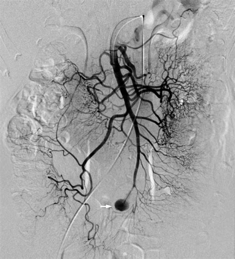 Selective Angiography Of The Sma Reveals That There Is A Saccular