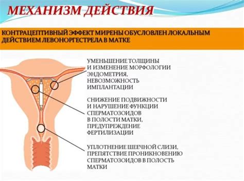 Внутриматочная спираль (ВМС) — плюсы и осложнения контрацепции