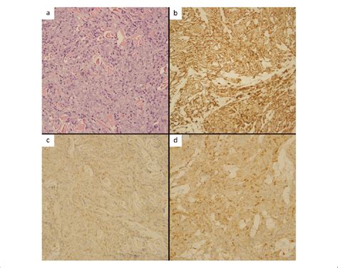 Histological Slides Obtained From A Punch Biopsy Of A Skin Lesion