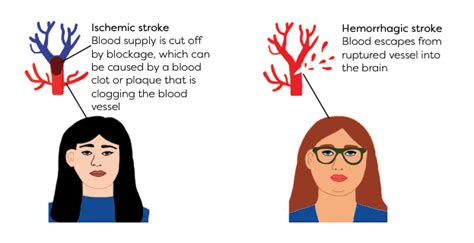 What Women Need To Know About Stroke Mayo Clinic Press