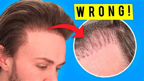 7 Reasons Why Hair Transplants Fail YouTube