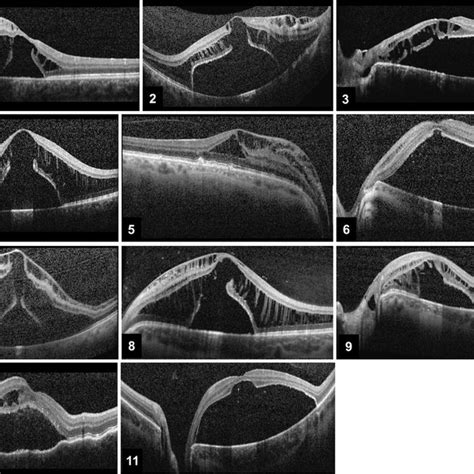 Partial Posterior Hyaloid Membrane Detachment Macular Relief Is