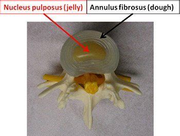 Disc Herniation Ashburn Va Spinal Stenosis Reston Va