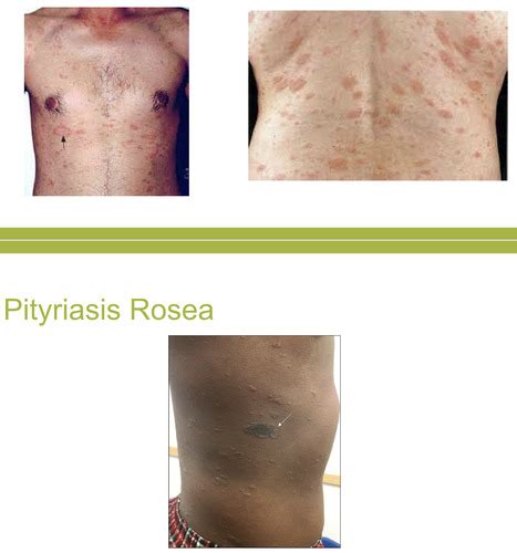 Common Scaling Eruptions And Non Infectious Inflammations And Disorders