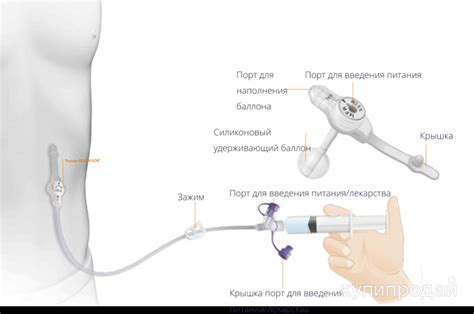 Низкопрофильная гастростомическая питательная трубка MIC-KEY в Москве