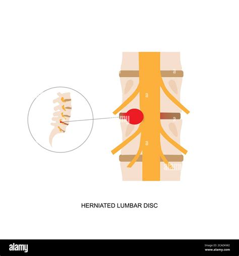 Illustration Demonstration Of Human Herniated Lumbar Disc Lumbar Disc