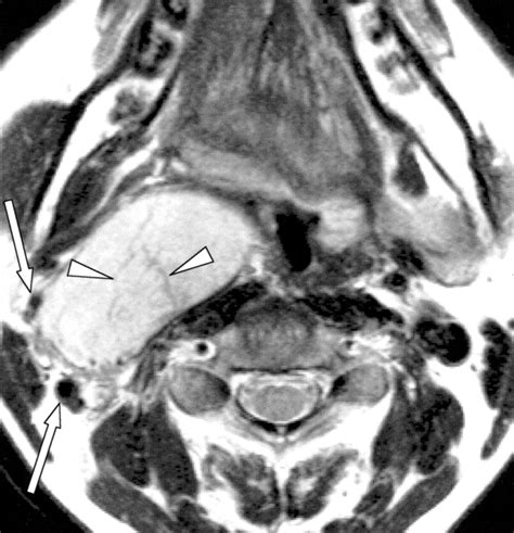 Imaging Of Parapharyngeal Space Lesions Focus On The Prestyloid