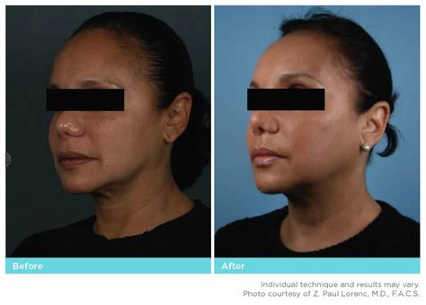 Botox Gallery Burnsville Mn And Lakeville Mn