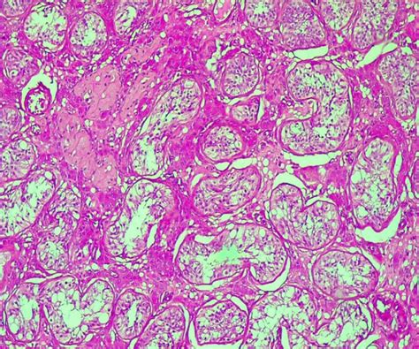 Ovotesticular Disorder Of Sex Development In A Xy Adolescent A Rare Case Report With Review