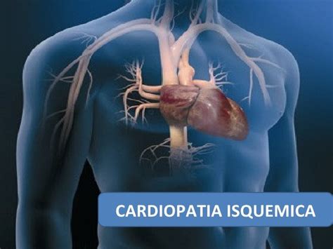 O Que É Cardiopatia Isquêmica - CARDIOPATIA ISQUEMICA