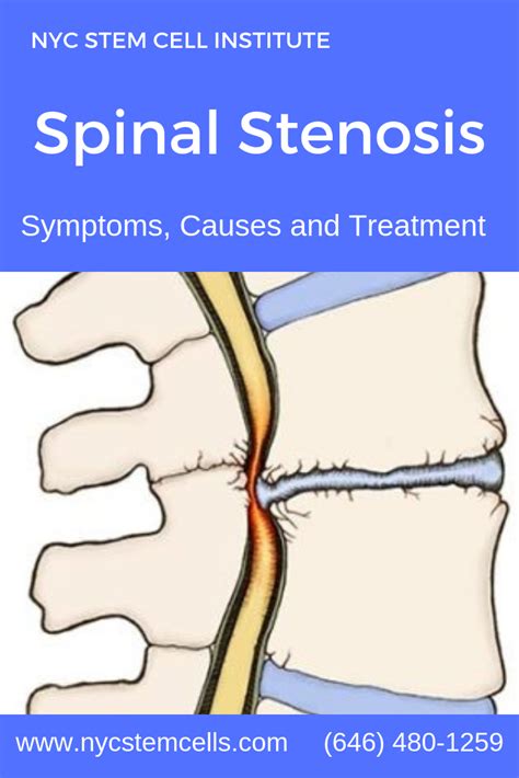 Spinal Stenosis Symptoms And Treatment