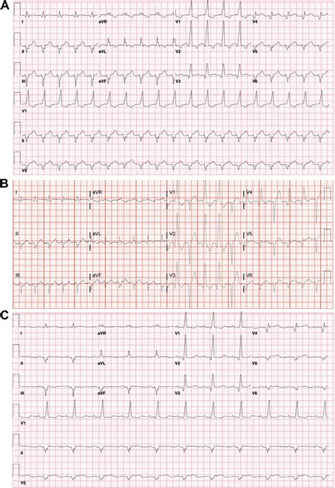 A The 12 Lead Electrocardiogram ECG During Wide Complex Tachycardia