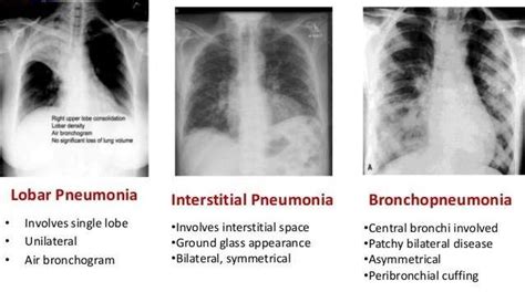 Lobar Pneumonia Vs Bronchopneumonia