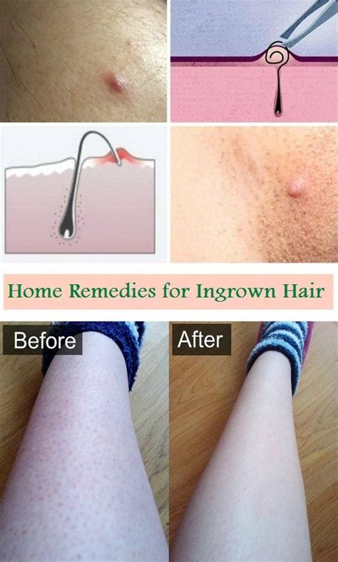 How To Remove Deep Ingrown Hair On Chin at Neil Bennett blog