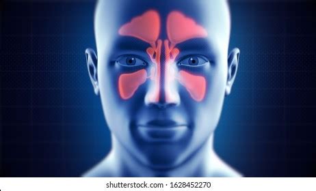 Nasal Sinus Infection Frontal Ethmoidal Sphenoidal Stock Illustration ...