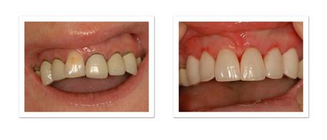 Porcelain Crowns From Winning Smiles Cosmetic Dentistry Team