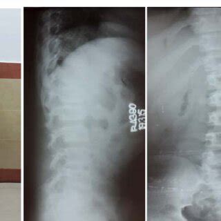 Showing Dorso Lumbar Scoliosis With Anterior Breaking At D12 L1 2 3