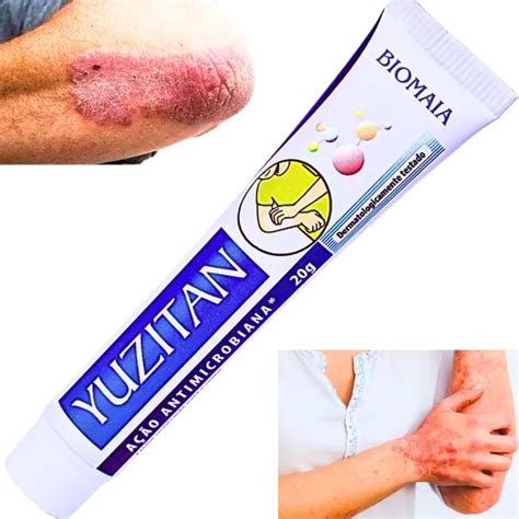 Melhor Pomada Para Dermatite De Contato - Pomada Para Dermatite Atópica Dermatite De Contato Derma | MercadoLivre