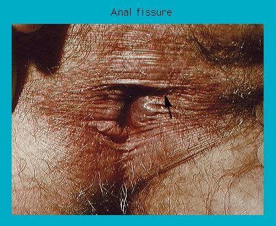 Photograph Of An Anal Fissure Primary Care Notebook