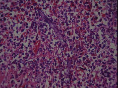 Fatal Disseminated Mucormycosis In An Immunocompotent Patient A Case