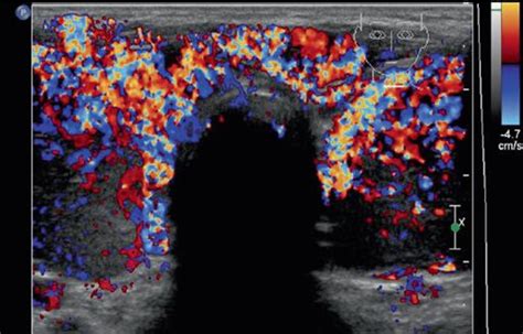 Figure 18 From Role Of Quantitative Doppler Assessment In The Differentiation Between Graves