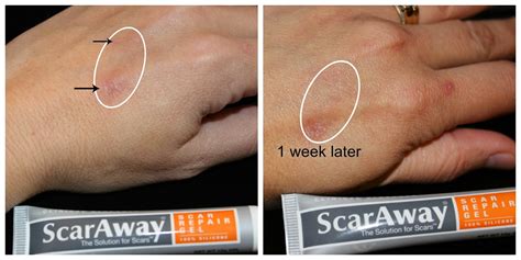 Scar Away Scar Repair Gel Heals New And Old Scars Parenting Healthy