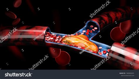 혈전: 3,087개가 넘는 로열티 프리 라이선스 대상 스톡 일러스트 및 그림 | Shutterstock