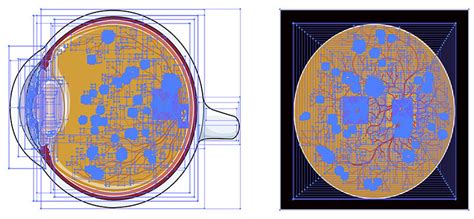 Diabetic Retinopathy Vector Illustration