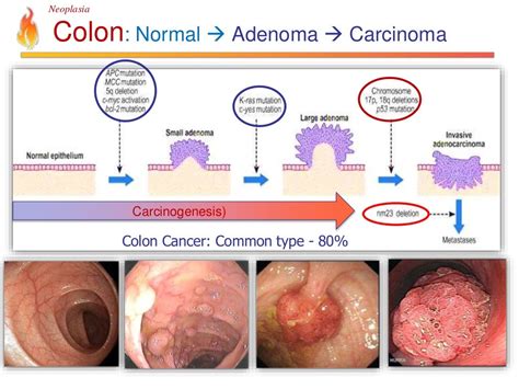 Pathology Lecture Neoplasia