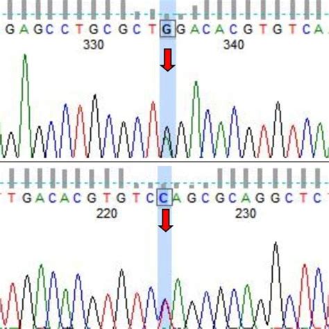 Sanger Sequencing Validation Results Of The Pathogenic Mutation Of The