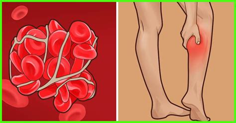 13 Home Remedies To Heal Leg Ulcers And Prevention Tips