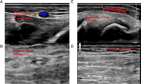 Ultrasound Guided Radial Arterial Catheterization In Patients With Regurgitant And Stenotic Left