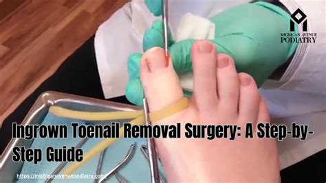 Ingrown Toenail Removal Surgery A Step By Step Guide