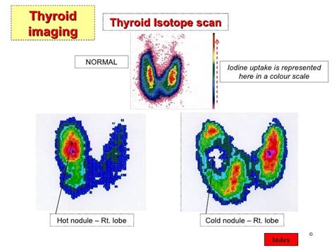 Thyroid Presentation